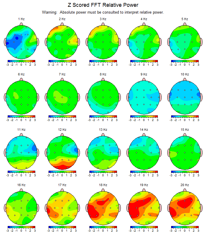 Michelle's follow-up scan in February 2013 after the four day Advanced Workshop.  The green areas in the images represent normal and balanced brain activity.