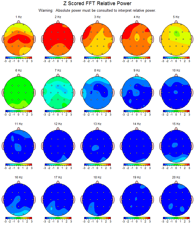 Michelle's brain scan from February 2013. The blue areas indicate a decreased level of cognitive activity.